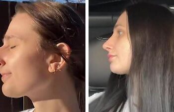 USA: Frau lässt sich die Nase operieren – und trennt sich anschließend von ihrem Mann