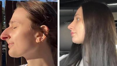 USA: Frau lässt sich die Nase operieren - und trennt sich anschließend von ihrem Mann USA: Frau lässt sich die Nase operieren – und trennt sich anschließend von ihrem Mann